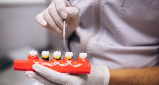 Edremit Diş İmplantı Fiyatları